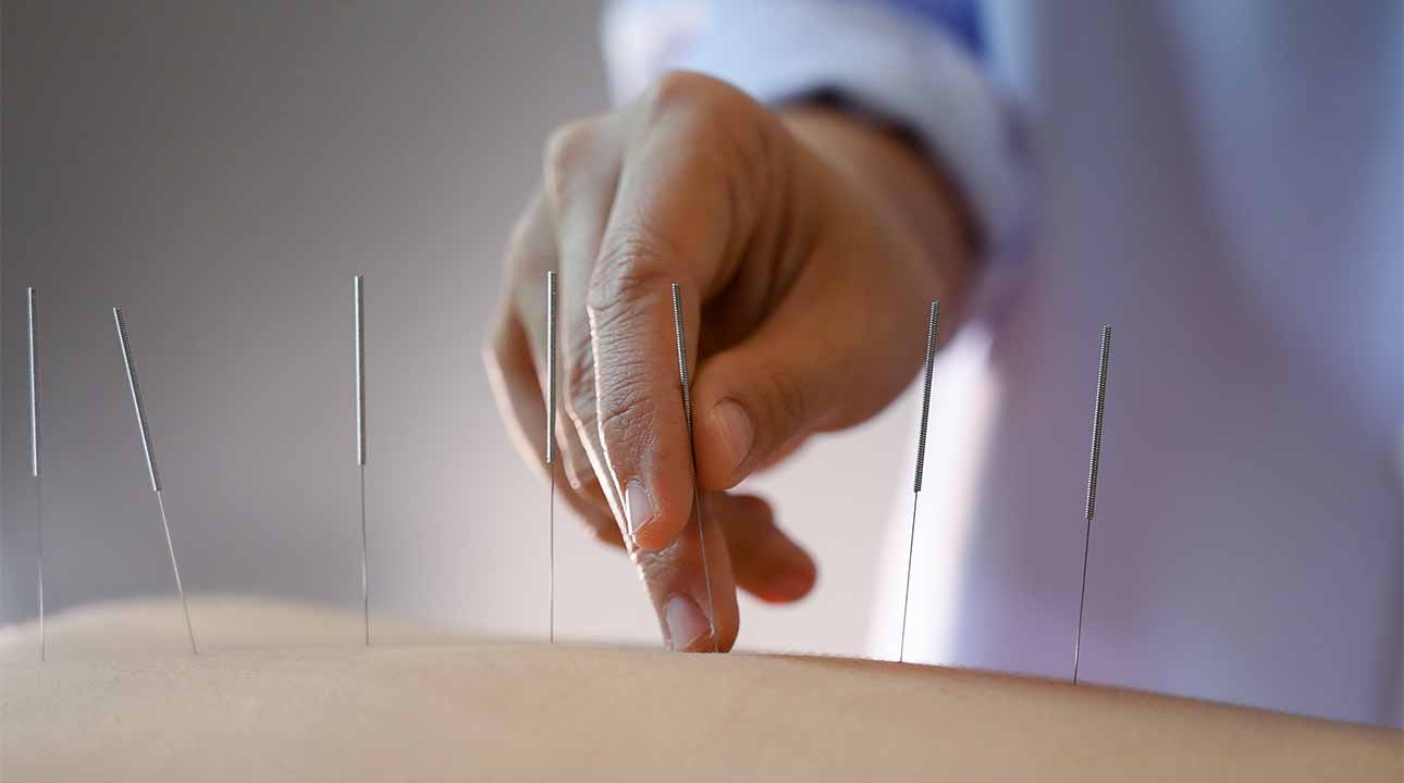 acupuncture C'est quoi la médecine holistique et alternative ?